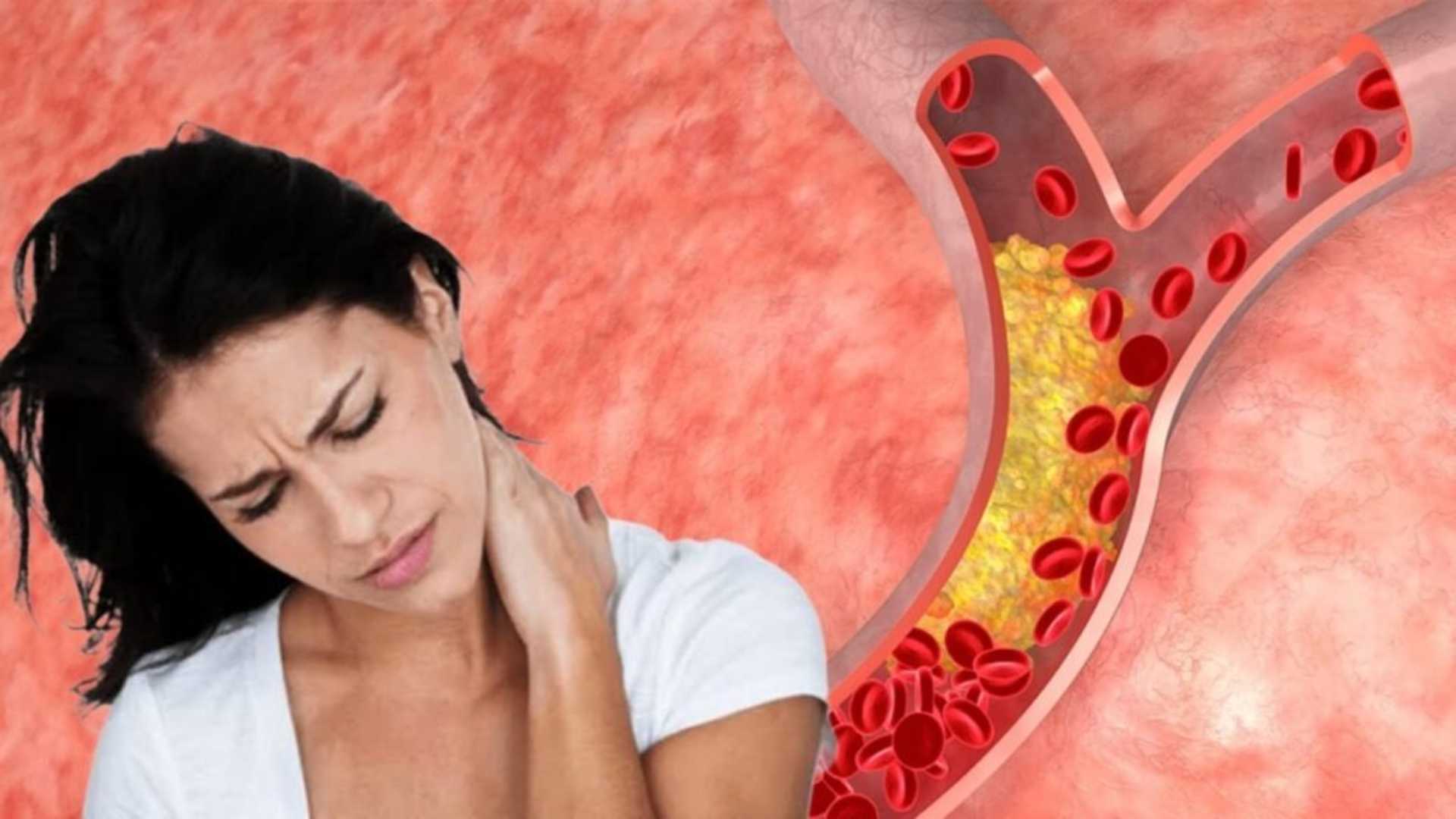 High Cholesterol Symptoms
